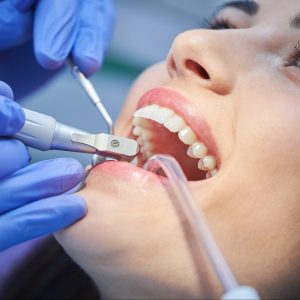 Teeth Cleaning | General Dental Services