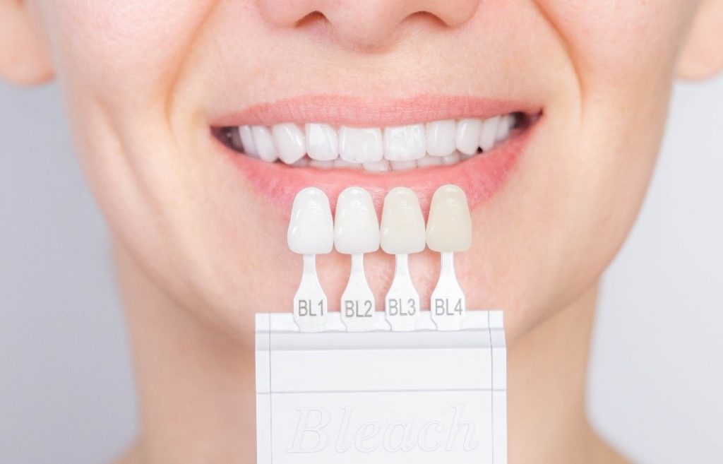 Check out six things you need to know before getting porcelain veneers, including the process and costs.