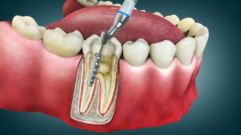 Root Canal Therapy Illustration | Root Canal Preparation Tips | Dentistry at Ivy Falls