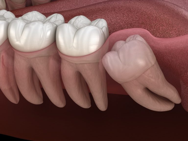 Graphic of Tooth Needing Emergency Wisdom Tooth Removal | Dentistry at Ivy Falls