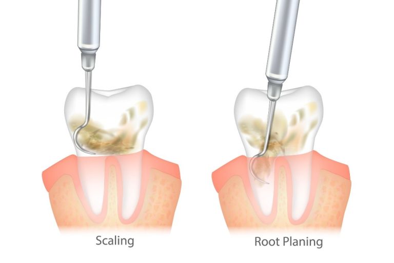 Scaling and Root Planing